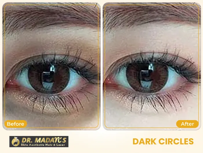 Dark circles before and after result 1 at Dr Madan Aesthetics